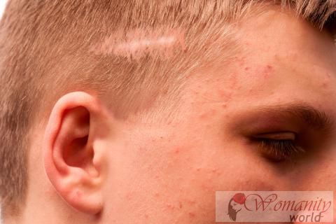 Littekens alopecia