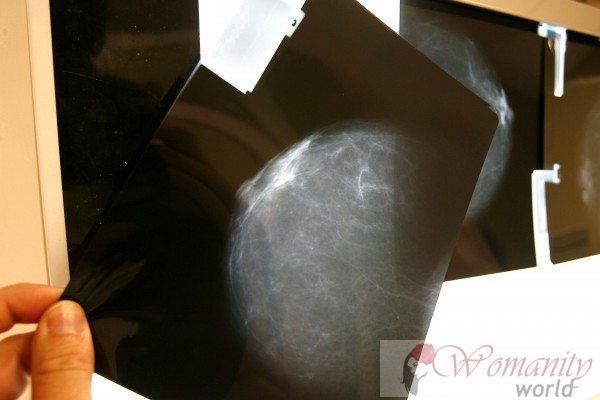 Radiologues ne croient pas nécessaire de faire une première mammographie à 35 ans
