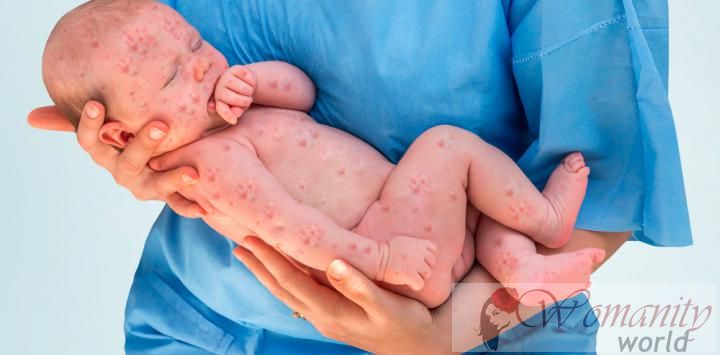 Neugeborenen-Herpes betrifft 14.000 Neugeborene jedes Jahr