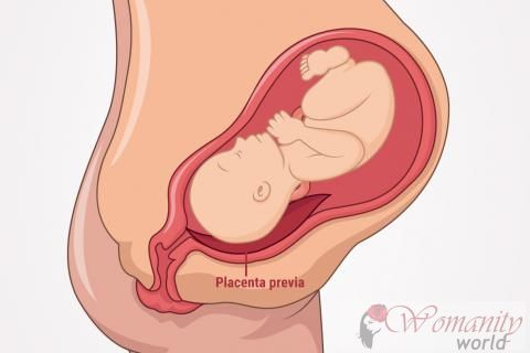 Quel est le placenta praevia et symptômes