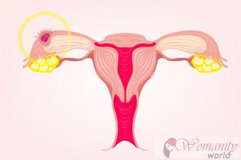 Les causes de la grossesse extra-utérine