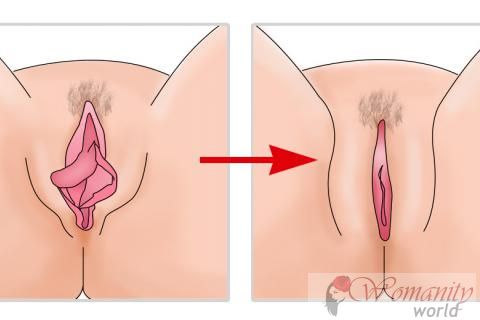 Labioplastia