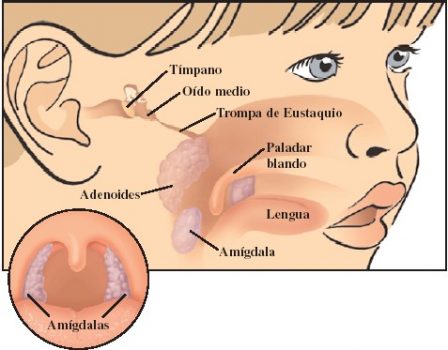Adenoidektomi. Adenoider hos barn, symtom och behandling