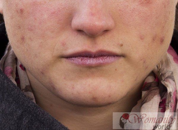 Les mythes de l'acné qui doivent être enlevés