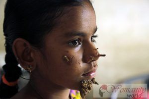 En flicka i Bangladesh, nytt påverkas av sällsynt sjukdom "träd man"